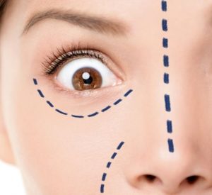 Cosmetic surgery lines drawn on face